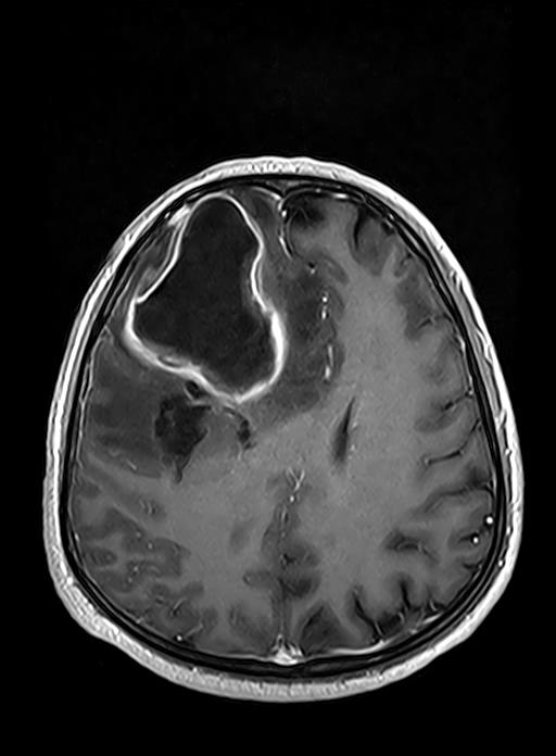 brain abscess