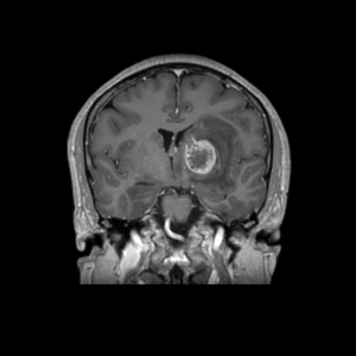 brain tumor