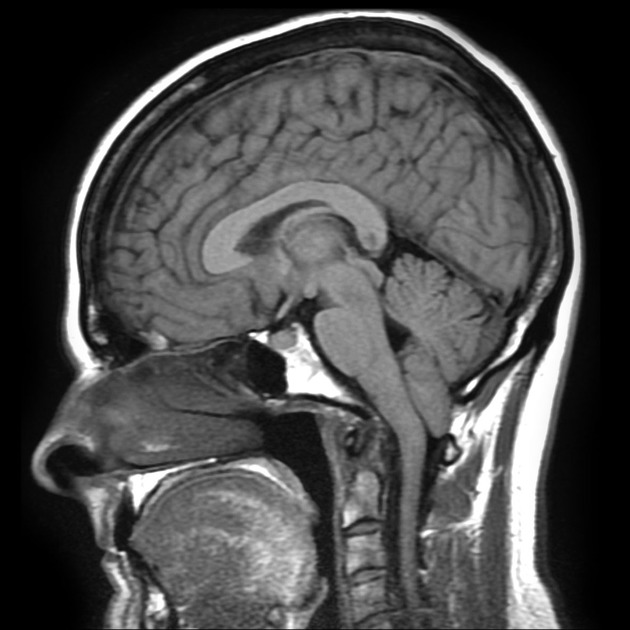 chiari