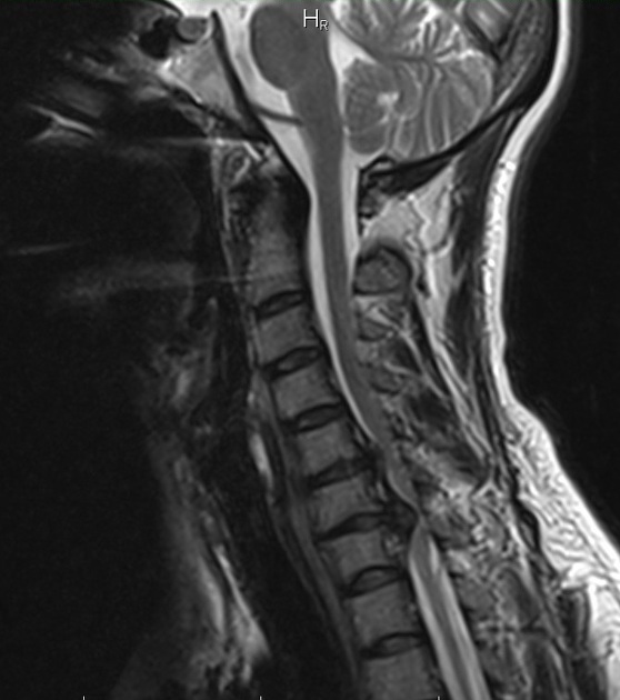cervical disc herniation