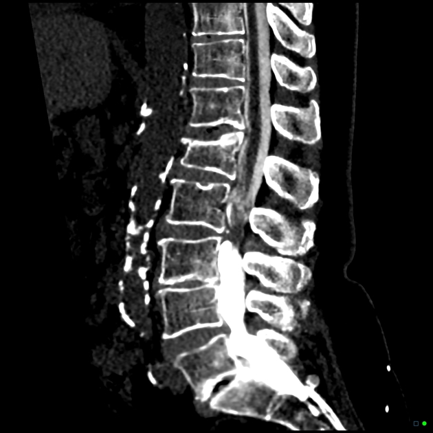 ct myelogram