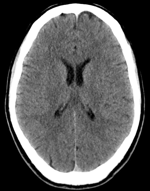 normal head ct
