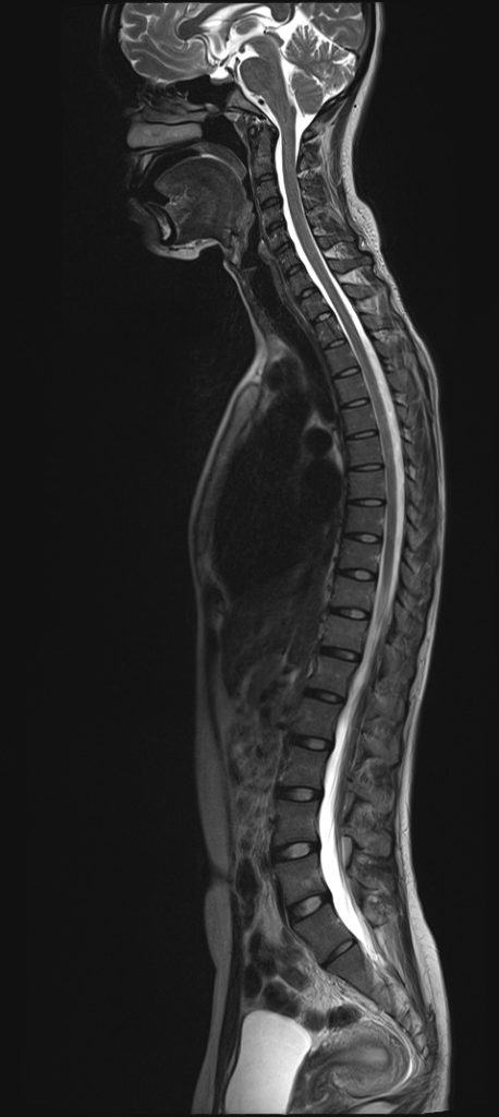 normal spine mri