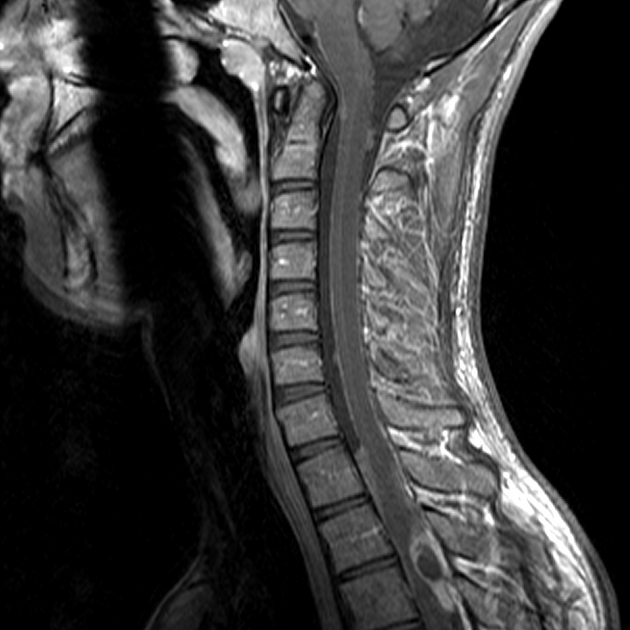 spine tumor