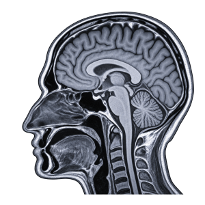 Read more about the article Chiari Malformation