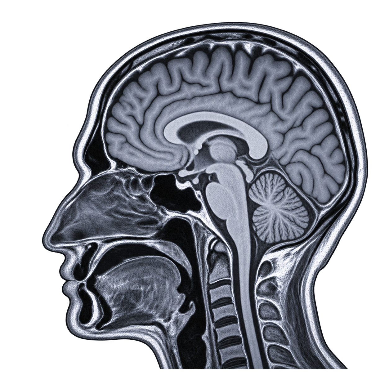 You are currently viewing Chiari Malformation
